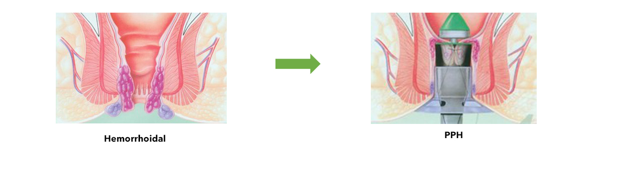 hemorrhoidal-stapler-indication.jpg hemorrhoidal-stapler-indication.jpg